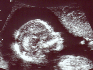 Ultraschall vom 2. Februar 2010